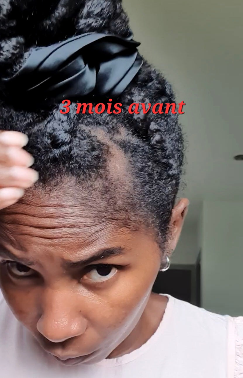 Dermaroller Stimule la pousse des cheveux